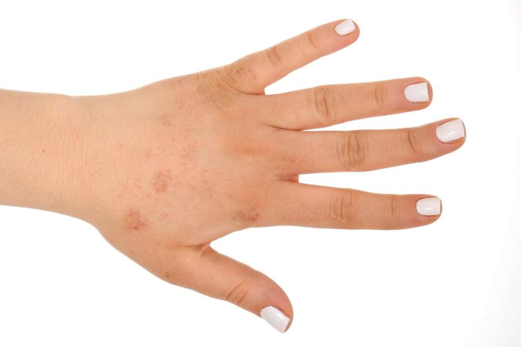 Unexplained skin rash could be new coronavirus symptom ...